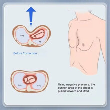 Pectus Excavatum Correction Cup Adult Children Sternum Rib Depression Deformity Thoracic Repair Physical Orthotic Tool M
