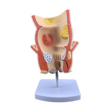 3D Sectional Pathology Teaching Model in PVC for Classroom Display and Rectal pathology