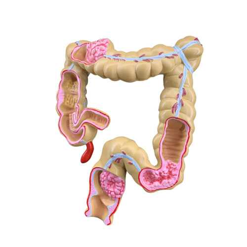 PVC Pathology Anatomy Model for Visual Classroom and Laboratory Pathological large i