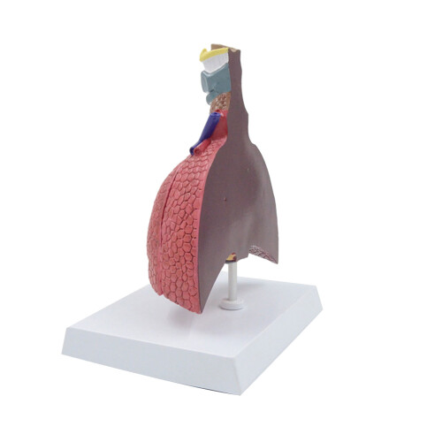 Pathological Lung Anatomy Model for Diseases Study Medical Lecture Report