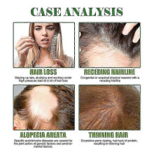 3Pcs Rosemary Mint Scalp Hair Growth Essential Oil Nourishing Hair Strengthening Treatment for Split Ends And Dry Hair