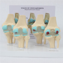 2X Kit de Genou Modèle D'Anatomie de L'Arthrose avec Carte-Clé Éducative Modèle de Genou en 4 Étapes Aides Pédagogiques Orthopédiques