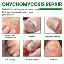 2X 2024 New Essential Oil Nail Fungus Repair Liquid Nail Thickening Discoloration Off Soft Nail Thickening Type Onychomyc 20ml