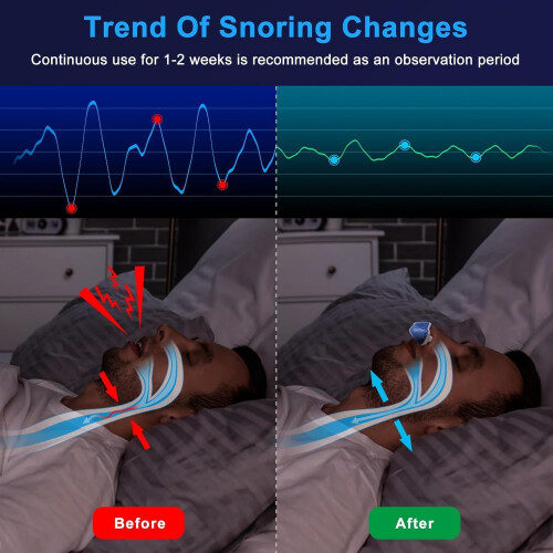 Anti Snoring Device Rechargeable Blue Mini 2