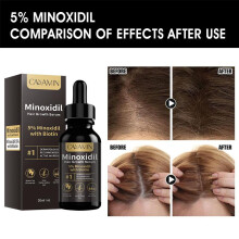 (3pcs) Minoxidil Solution 5% Hair Regrowth Treatment for Men and Women, Hair Loss Prevention Serum, Scalp Care Essence, 3 Pack