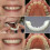 Smile Snap On False Teeth Lower 4