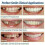 Smile Snap On False Teeth Lower 2