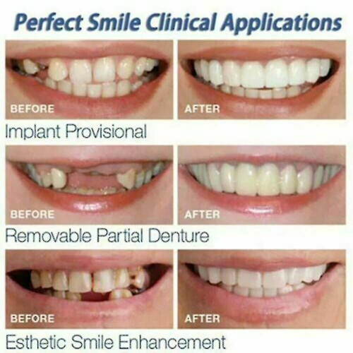 Smile Snap On False Teeth Lower 1