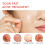 Salicylic acid tea tree essential oil acne patch 2