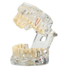Disease Teeth Model Dental Typodonts Implant Teeth Model with Removable Teeth Dentist Standard Tooth Demonstration