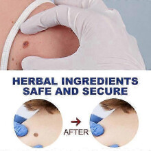 EELHOE Kuyou Liquid Pen for Gentle Skin Care, Body, and Face Care to Remove Skin Tags and Kuyou Liquid