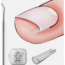 Ingrown Toenail Correction Set, 40 Pain-Free Toenail Smoothing Strips with Toenail Lifter, Easy Tool Kit for Ingrown Toenails