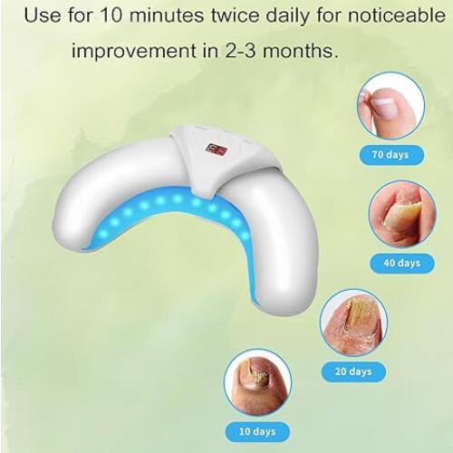 Cold Laser Nail Fungus Light Therapy Home Device 1