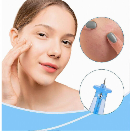 Blackhead Removal Tools, Disposable Blackhead Remover Tools, Blackhead Remover Set For Acne Removal, Whiteheads 1