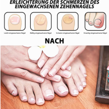 60-delige set voor de correctie van ingegroeide teennagels met pleisters, nagelknipper, nagelschaartje en pincet voor pedicure