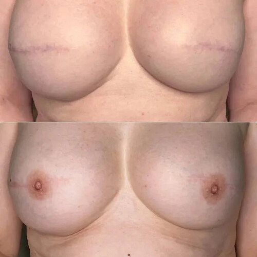 Hanafy Areola PRO Set by Pavel Somov 1