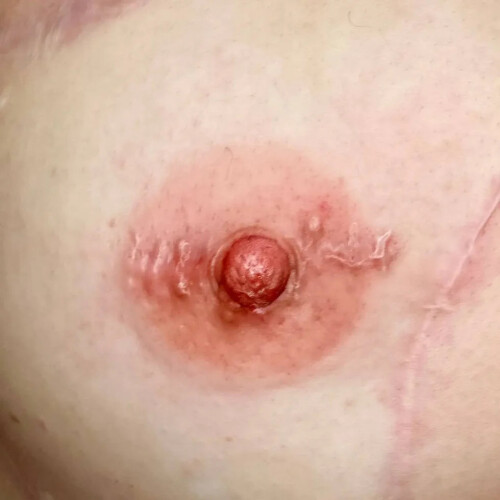 Hanafy Areola PRO Set by Pavel Somov 2