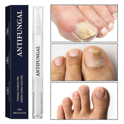 (2pcs) Αντιμυκητιασικό Στυλό Undecylenic Acid 25% Φροντίδα Νυχιών Ποδι