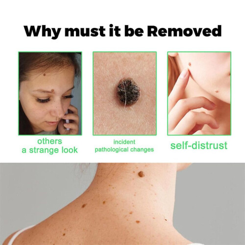 Σαπούνι Smoothskin για την εξάλειψη των κονδυλωμάτων Φυσικ 1