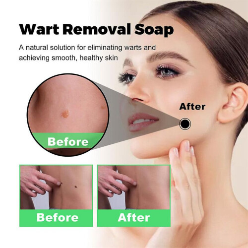 Σαπούνι Smoothskin για την εξάλειψη των κονδυλωμάτων Φυσικ 2