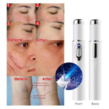 Blue Light Therapy Pen For Spider Veins Acne Removal Pen Scar Wrinkles Puffy Eyes Dark Circles Removal