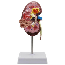 Anatomisches Modell der Menschlichen Niere mit Pathologien - Realistisches Lehrmittel für das Studium der Nephrologie und Urologie